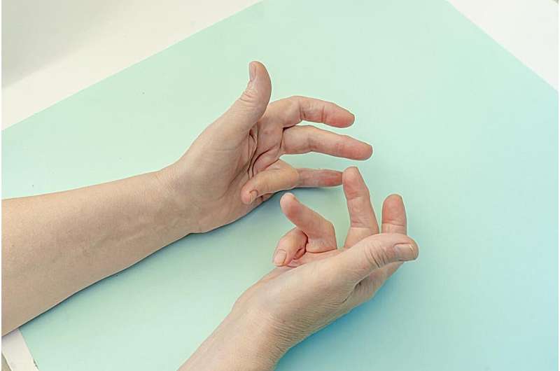 Collagenase not noninferior for dupuytren contracture