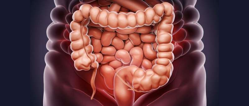 colon cancer